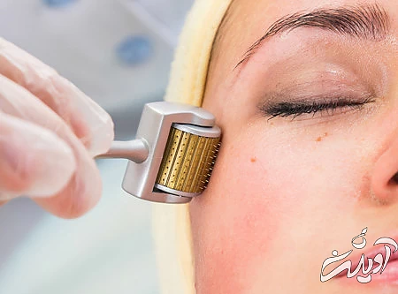 درمان قرمزی جای جوش از بین بردن قرمزی جای جوش صورت, از بین بردن جای جوش با لیزر, راه های از بین بردن جای جوش